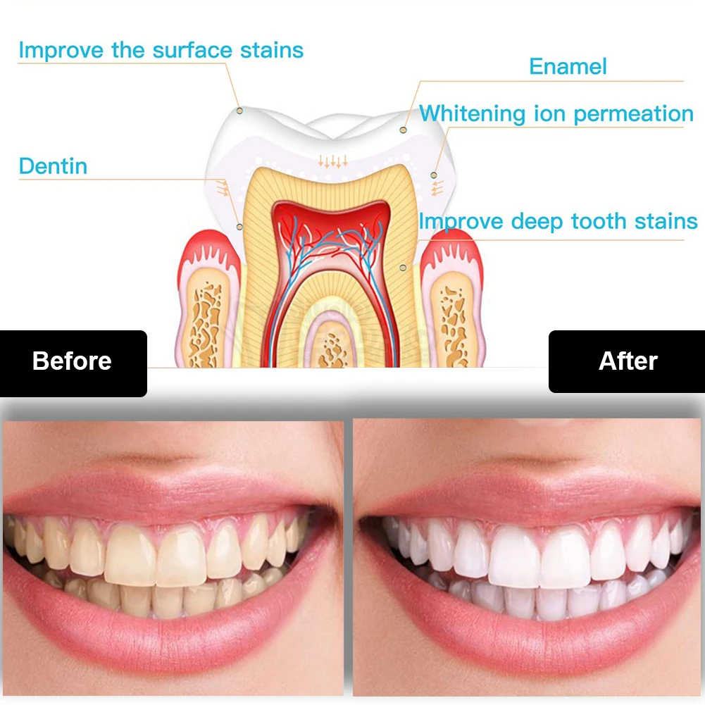 Dental Teeth Whitening Kit Min - Teeth Whitening Essence 评论和价格