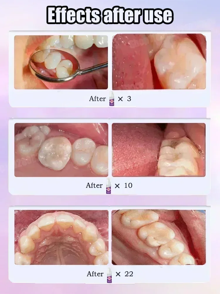 Teeth Cleaning Toothpaste Remo - Teeth Whitening Treatment 评论和价格